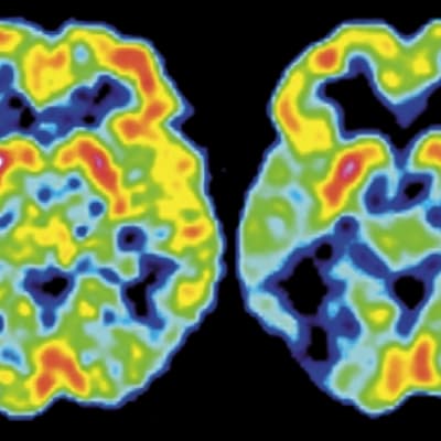 PET-kuva Alzheimerin tautia sairastavan aivoista