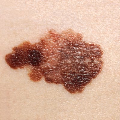 Närbild på melanom, en mörk, oregelbunden fläck på huden.