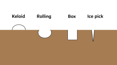 Illustration av de olika ärren: Keloid (som står upp) och rolling, box och ice pick som går ner i huden. 