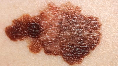 Närbild på melanom, en mörk, oregelbunden fläck på huden.