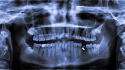 En panoroamröntgen av en mun, ett litet eurotecken syns i en av tandgluggarna.