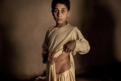 En pojke håller upp en tröja och visar ett ärr på magen.