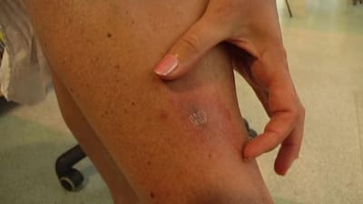 Borrelioosin aiheuttama ihomuutos sääressä.