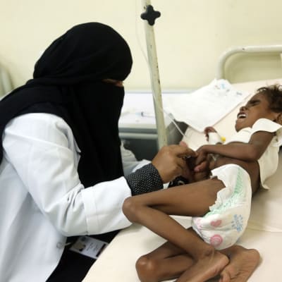 Ett undernärt barn behandlas på ett sjukhus i den jemenitiska hamnstaden Hodeidah den 5 november 2017.