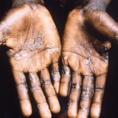 En person visar upp sina hudutslag som personen har i händerna. Utslagen har som orsakats av apkoppor. 