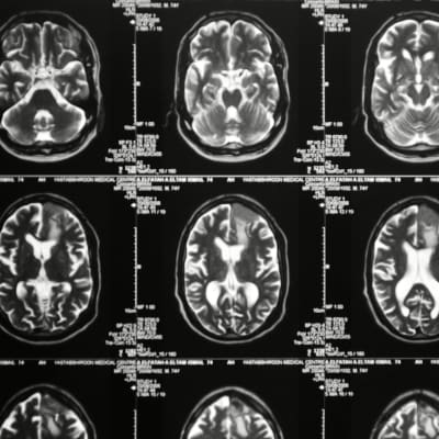 Magnetresonanstomografibilder av en hjärna.