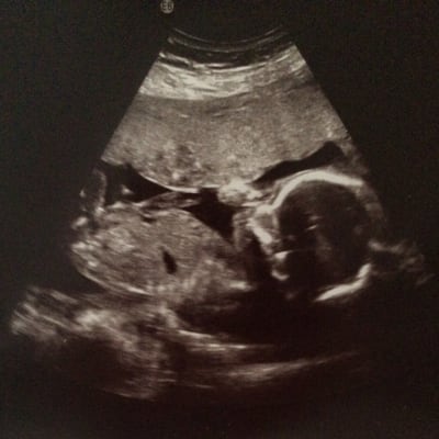 Ultraljudsbild på ett foster. 