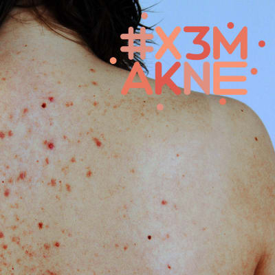 En naken rygg med akne och #x3makne logo