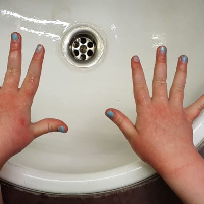 Lapsen märät kädet, joiden iho punertaa käsien pesun jälkeen lavuaarin yläpuolella.