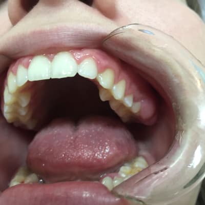 En mun med lätt gula tänder undersöks