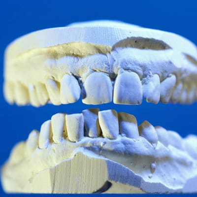 Den som behöver tandproteser har många alternativ att välja mellan. Bild: YLE/Goodshoot.com/Ludovic Di Orio