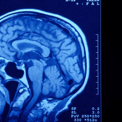 Röntgenbild på en hjärna.