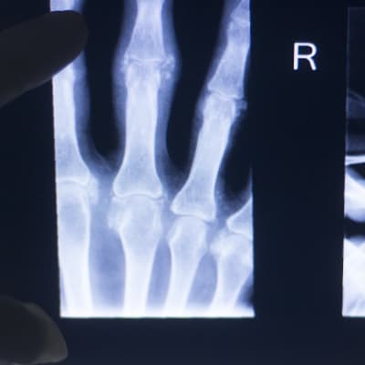 En röntgenbild av en hand och ett finger som pekar mot den.