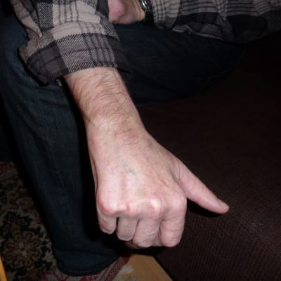 Tony Axberg visar sin handled som krossades. En nervskada har lett till svår värk dygnet runt