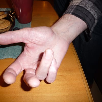 Tony Axberg visar sin handled som krossades. En nervskada har lett till svår värk dygnet runt, ringfingret och lillfingret går inte att räta ut