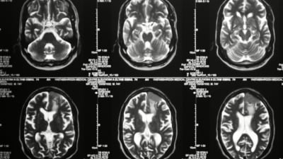 Magnetresonanstomografibilder av en hjärna.