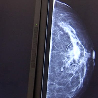 Mammografiakuva naisen rinnassa olevasta syöpäkasvaimesta.