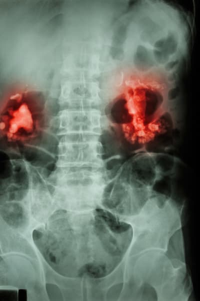 Röntgenbild av njurarna. Njurarna är röda på bilden, resten i svartvitt.