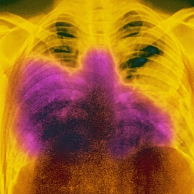 En röntgenbild visar en gulfärgad bröstkorg med rosa fläck i mitten.