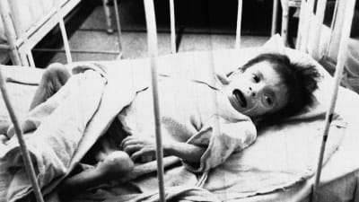 Föräldralöst barn på AIDS-avdelningen på sjukhus i Bukarest, Rumänien 1990