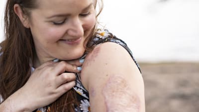 Katja Tamminen katsoo arpea omassa olkavarressaan