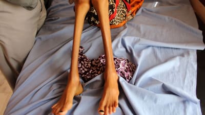 Tolvåriga Fatima Hadi vårdades för sin akuta undernäring på ett sjukhus i Hajjah i slutet av februari. 