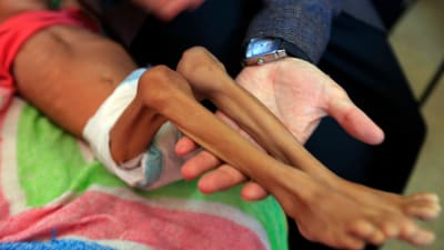 Ett undernärt barn på sjukhuset i huvudstaden Sanaa den 6 oktober. 14 miljoner människor i landet hotas av svält. 