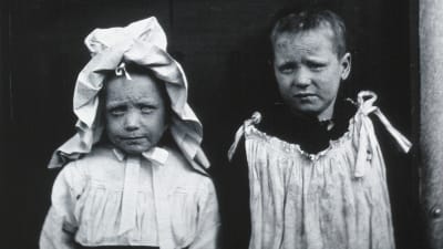Två barn som har haft smittkopporna.