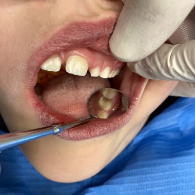 tandläkare petar med verktyg i munnen på ung patient.
