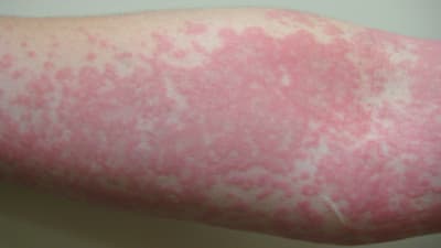nässelutslag på underarm