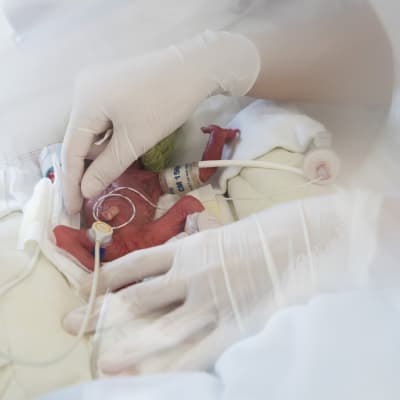 Barn födda före den 28 graviditetsveckan räknas som extremt tidigt födda. En arkivbild på en liten prematur i Ungern i november 2018. 