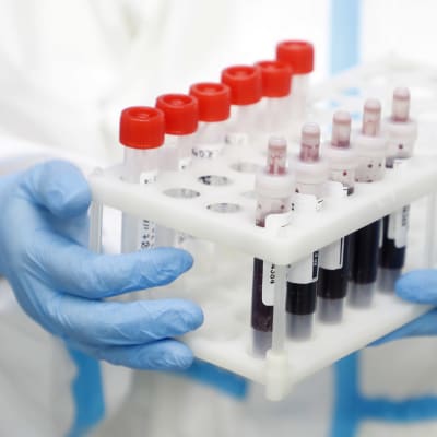 Närbild på blodprovstuber, en person med vit laboratorierock och blå plasthandskar håller i dem.