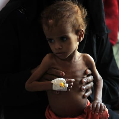 Utmärglat barn i Jemen. 