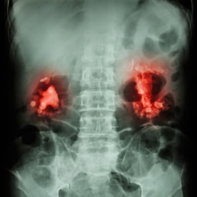 Röntgenkuva, jossa munuaiset näytetään punaisella värillä.