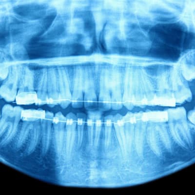 Rönrgenbild av tänder.