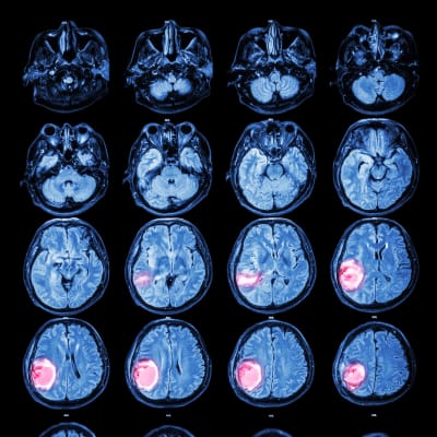 Röntgenbilder av en hjärna med cancertumör.