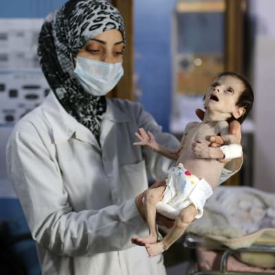 Ett allvarligt undernärt barn på en klinik i staden Hamouria, östra Ghouta i Syrien. Bilden tagen 21.10.2017