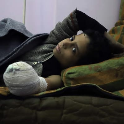 Den syriska pojken Khaled al-Ghorani vårdades på en klinik i östra Ghouta den 1 mars. Hans hand amputerades efter att han kommit till skada i ett flyganfall. 