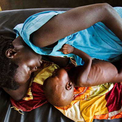 Ett undernärt barn och mamman i Sydsudan.