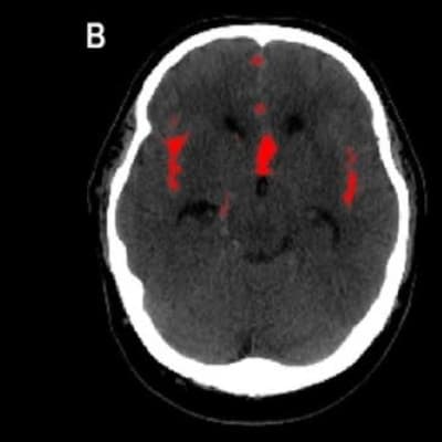 Kuvassa A näkyy pään TT-kuvassa laaja-alainen SAV. Kuvassa B on punaisella merkitty alueet, joissa algoritmi on havainnut verta.