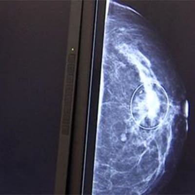 Bröstcancer