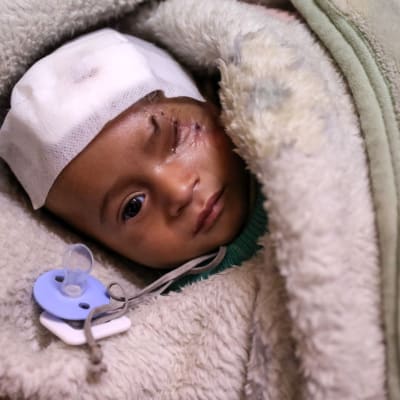 Det nyfödda barnet Karim har skadats två gånger i bombräder i Ghouta. Han har förlorat sitt öga och sin mamma. 