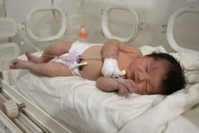 En bebis med mörkt hår och ett blåmärke över ena ögat ligger i en kuvös med kanyl fäst vid ena handen.