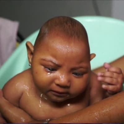 Pienipäisenä zika-viruksen takia syntynyt brasilialaisvauva
