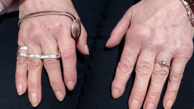 Raili markkanens händer är förvridna efter över 30 års ledgångsreumatism. 