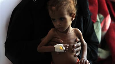 Utmärglat barn i Jemen. 