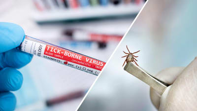 Bildcollage. Till vänster syns ett blodprov för TBE-virus, till höger en hand som håller i en fästing med en pincett.