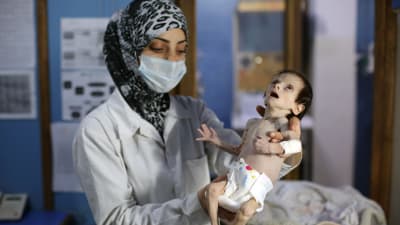 Ett allvarligt undernärt barn på en klinik i staden Hamouria, östra Ghouta i Syrien. Bilden tagen 21.10.2017