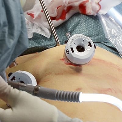 Lihavuusleikkausta tehdään tähystysmenetelmällä leikkaussalissa.