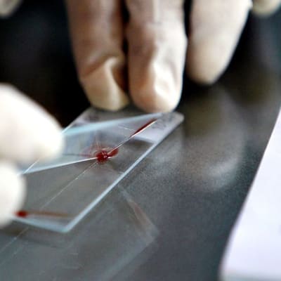 Verinäytettä valmistellaan malariatestiä varten.